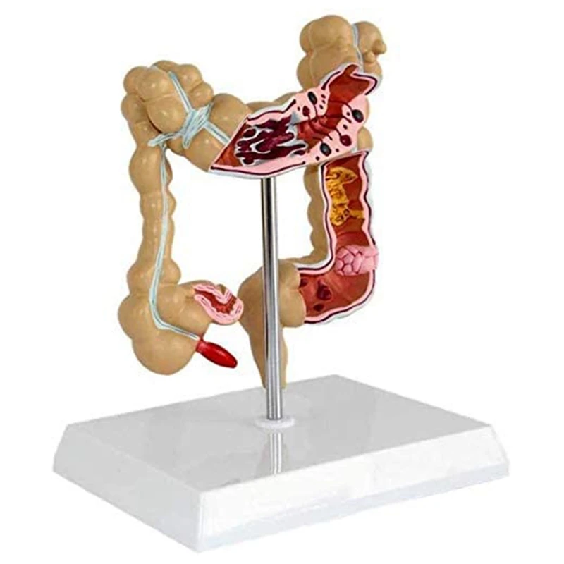 Модель патологического колоректального рака толстой кишки, модель Желудочно-кишечного тракта, Анатомическая модель